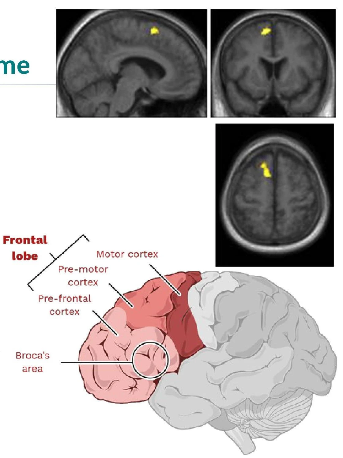 Diagram of the frontal lobe of the human brain, highlighting areas such as the motor cortex, pre-motor cortex, pre-frontal cortex, and Broca's area. The top panels show MRI scans with highlighted regions.