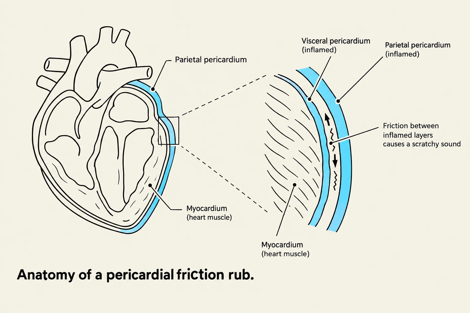 An illustration depicting the anatomy of a pericardial friction rub, showing the inflamed visceral and parietal pericardium layers of the heart and the resulting friction that causes a scratchy sound.