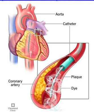 Illustration of a catheter being inserted into a coronary artery to visualize plaque buildup.