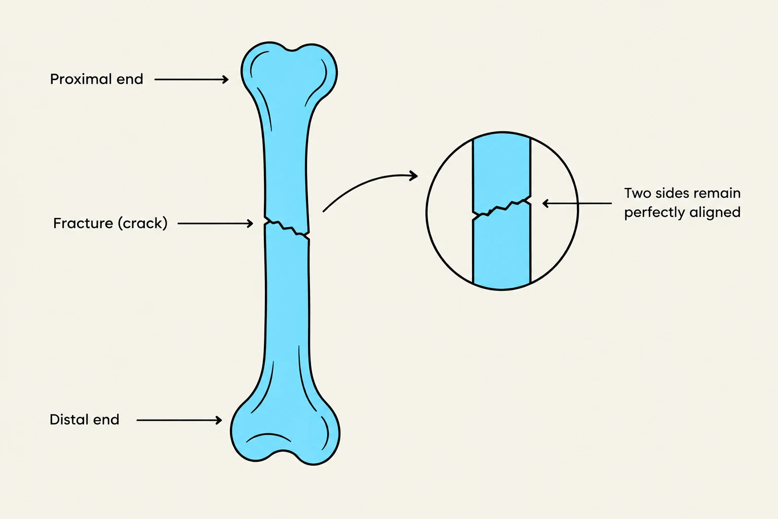Diagram illustrating a bone fracture where the two broken ends remain perfectly aligned.