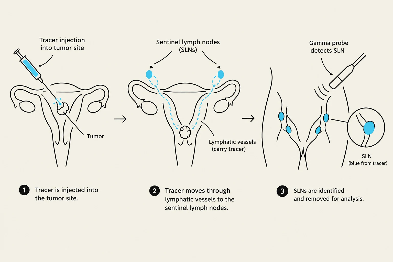 Diagram illustrating the sentinel lymph node biopsy procedure, where a tracer is injected into a tumor site, travels through lymphatic vessels to sentinel lymph nodes, which are then identified and removed for analysis.