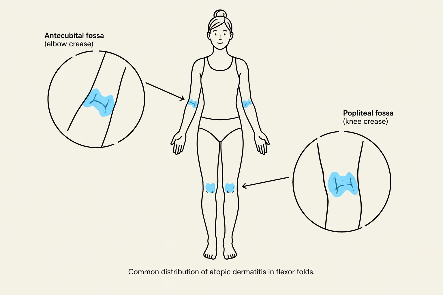 Common distribution of atopic dermatitis in flexor folds.