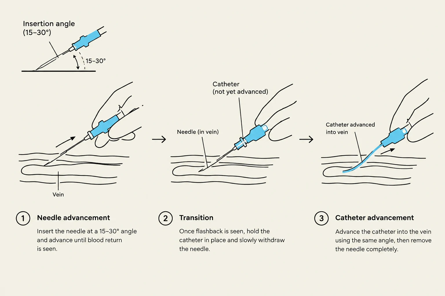 Diagram illustrating the steps for inserting a catheter into a vein, including needle advancement, transition, and catheter advancement.