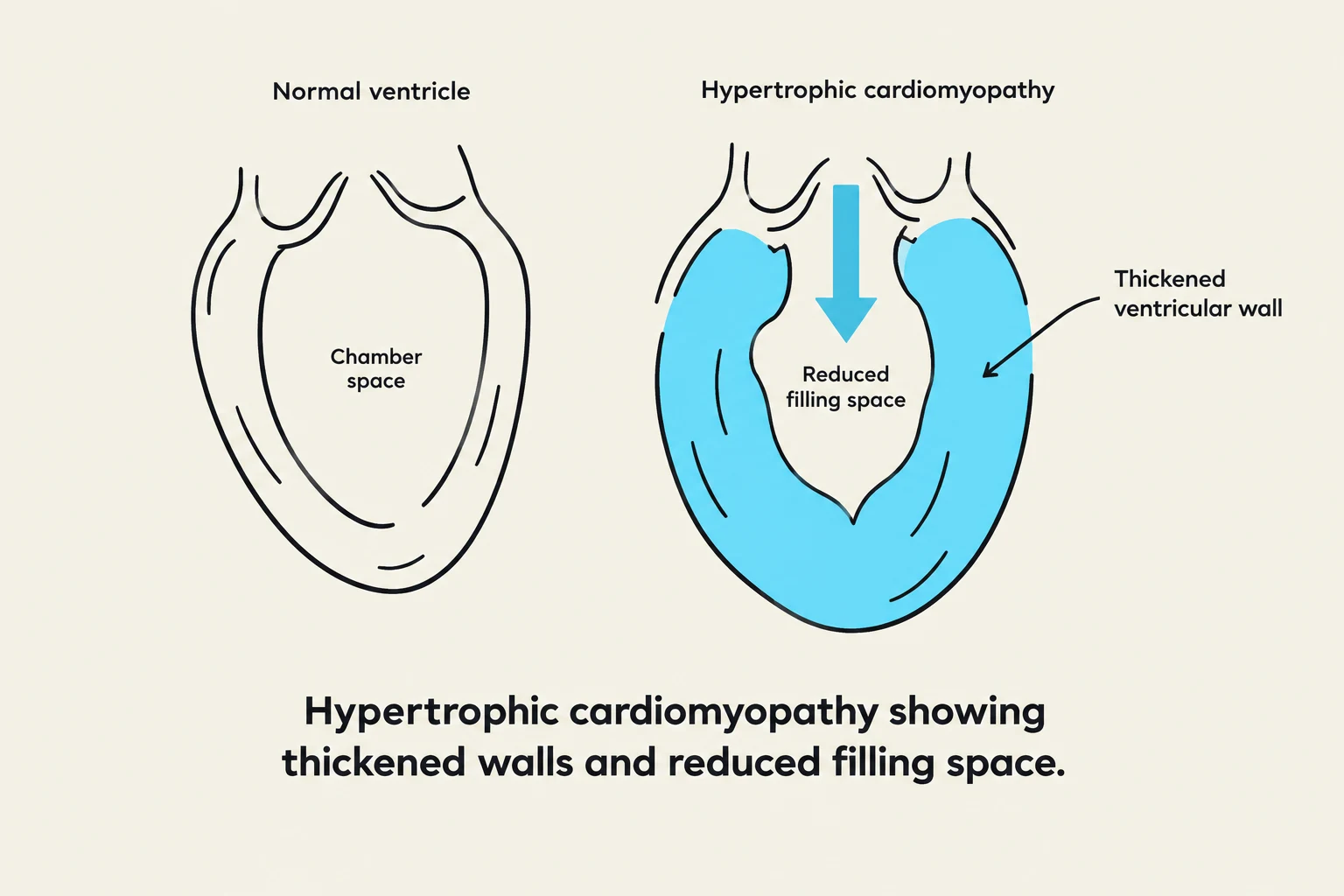 Comparison of a normal ventricle with a ventricle affected by hypertrophic cardiomyopathy, illustrating thickened walls and reduced filling space.