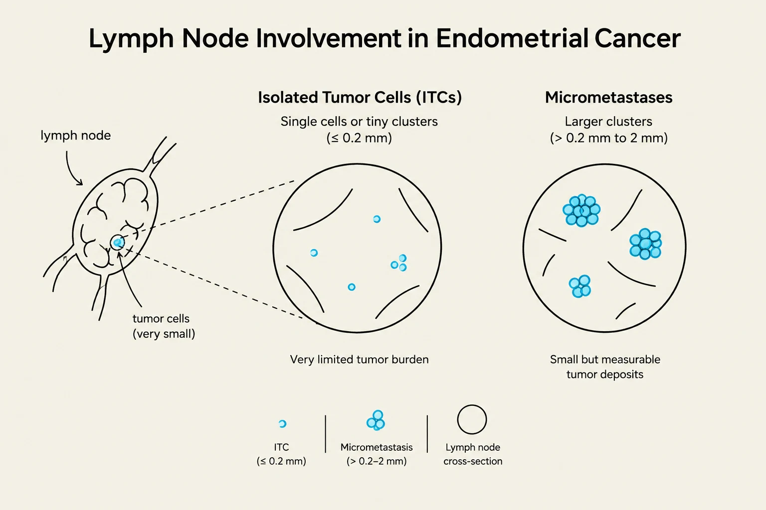 This diagram illustrates lymph node involvement in endometrial cancer, differentiating between isolated tumor cells (ITCs) and micrometastases based on size and cellularity.