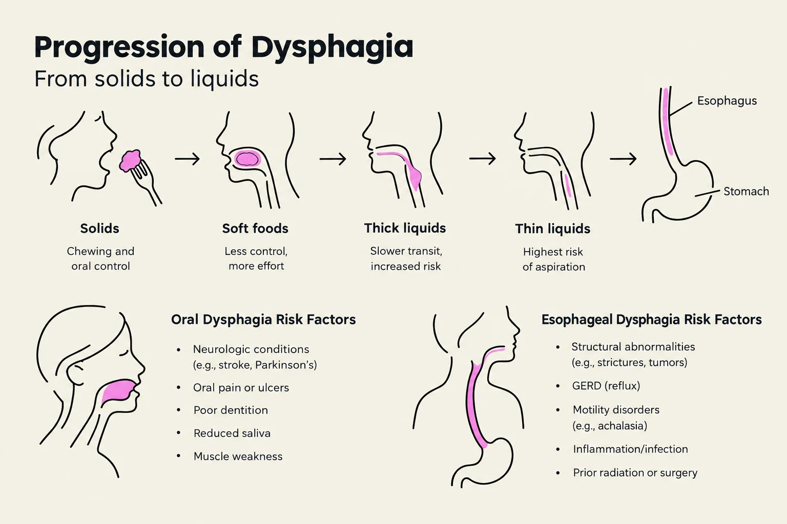 This diagram illustrates the progression of dysphagia, detailing how difficulty swallowing changes from solids to liquids, and lists risk factors for both oral and esophageal dysphagia.