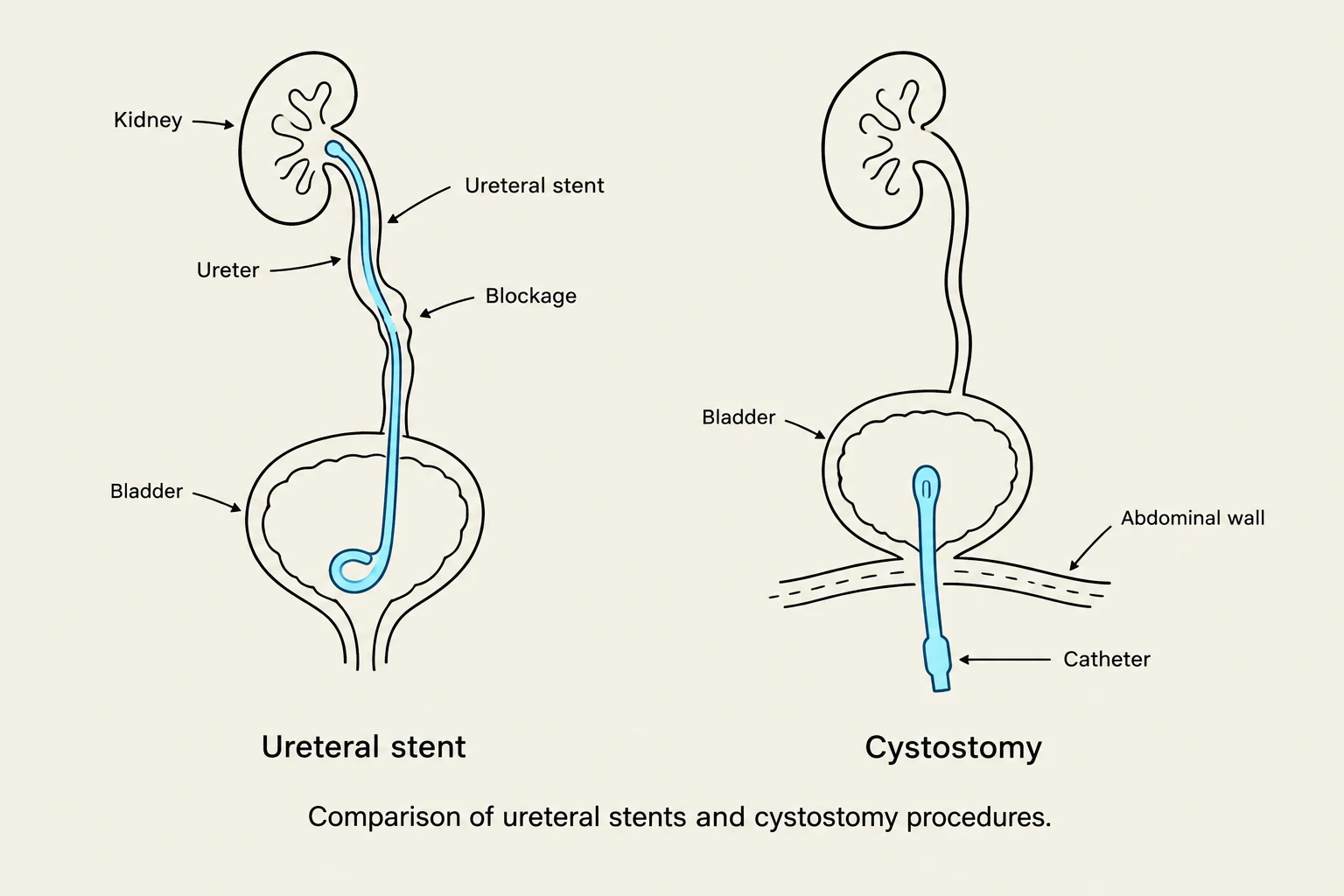 Comparison of ureteral stents and cystostomy procedures.