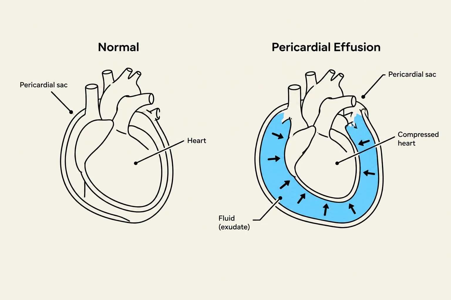 Diagram illustrating a normal heart and a heart with pericardial effusion, where fluid accumulates around the heart, compressing it.