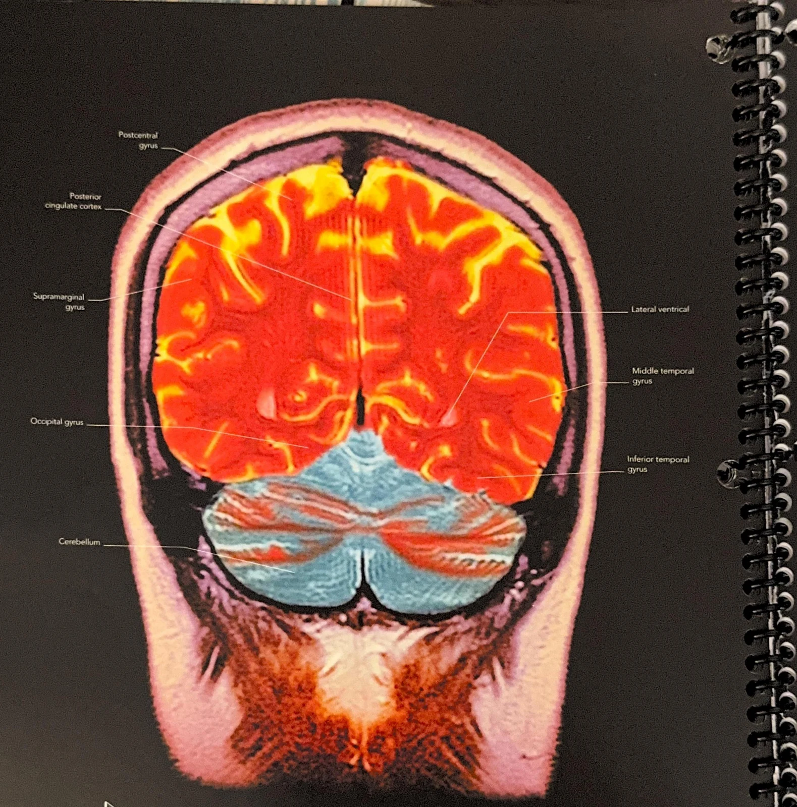 An anatomical illustration of a coronal view of the human brain, labeling various gyri, the cerebellum, and the lateral ventricle.