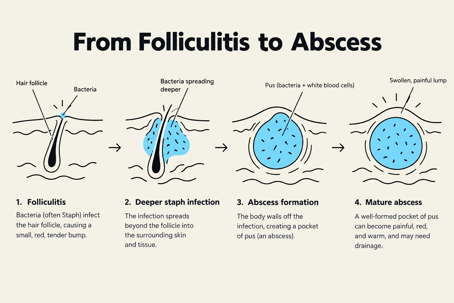 This diagram illustrates the progression of a skin infection from folliculitis to a mature abscess, showing the stages of bacterial infection, inflammation, and pus formation.