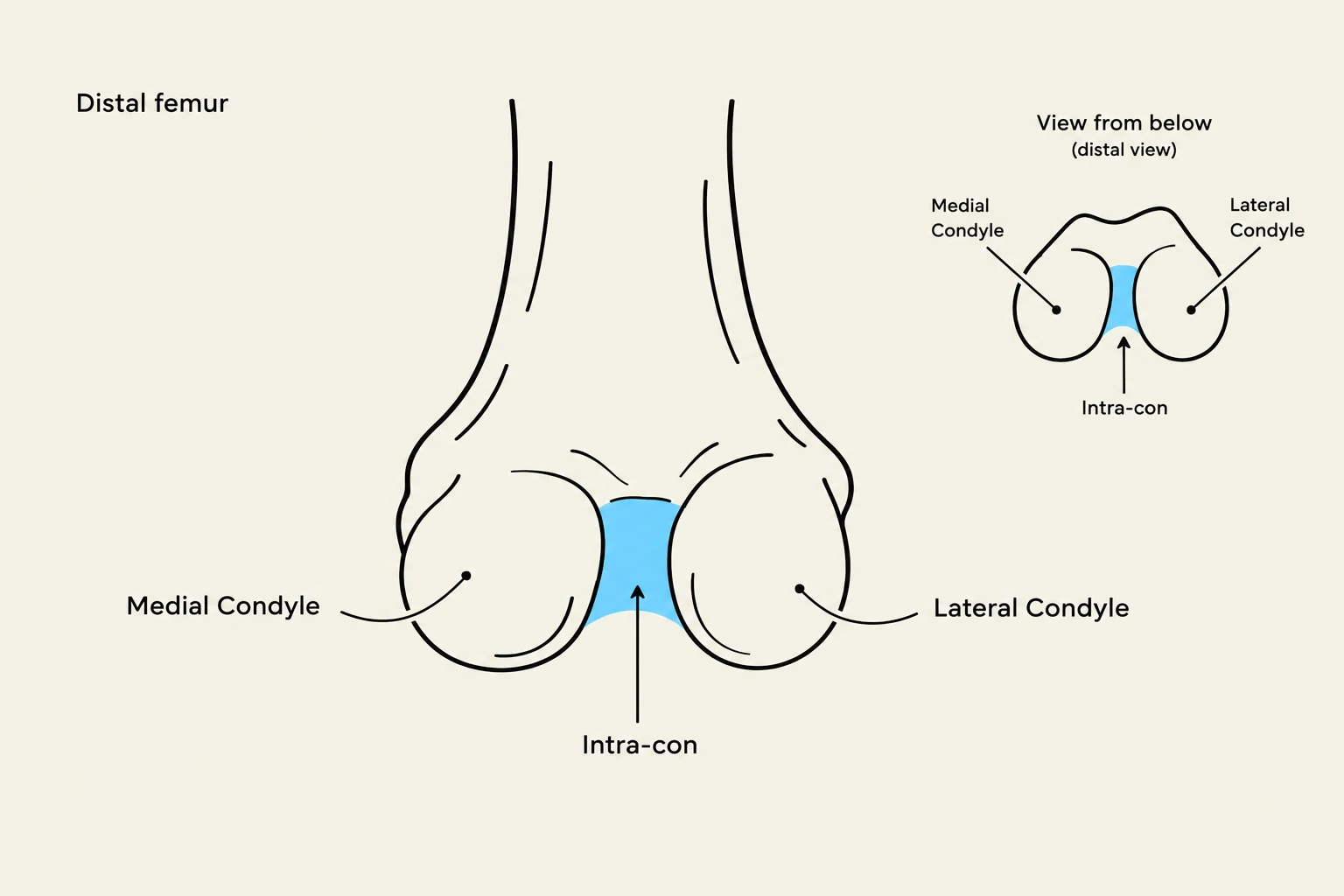 Diagram illustrating the distal end of the femur, showing the medial and lateral condyles and the intercondylar area (Intra-con).