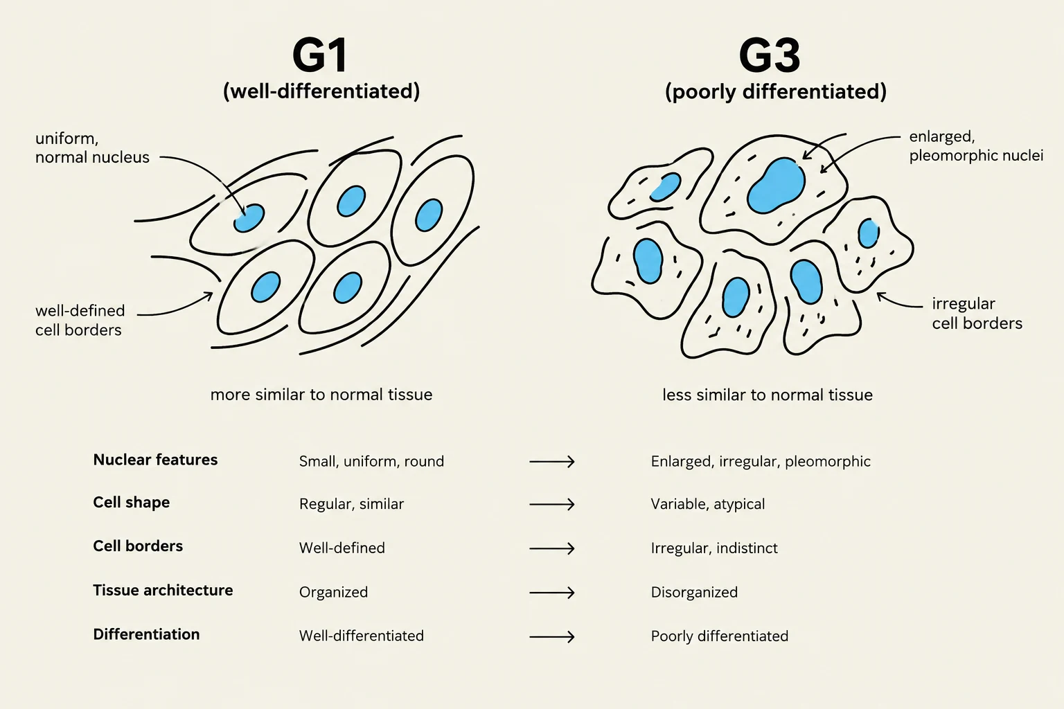 Comparison of well-differentiated (G1) and poorly differentiated (G3) cells, illustrating differences in nuclear features, cell shape, cell borders, tissue architecture, and overall differentiation.