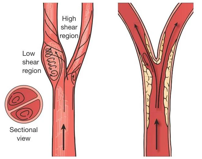 Diagram illustrating blood flow dynamics in a bifurcating artery, highlighting regions of high and low shear stress and the potential for plaque buildup.