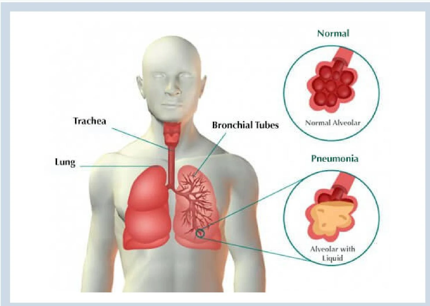This illustration shows a comparison between normal alveoli and alveoli affected by pneumonia, highlighting the presence of liquid in the latter.