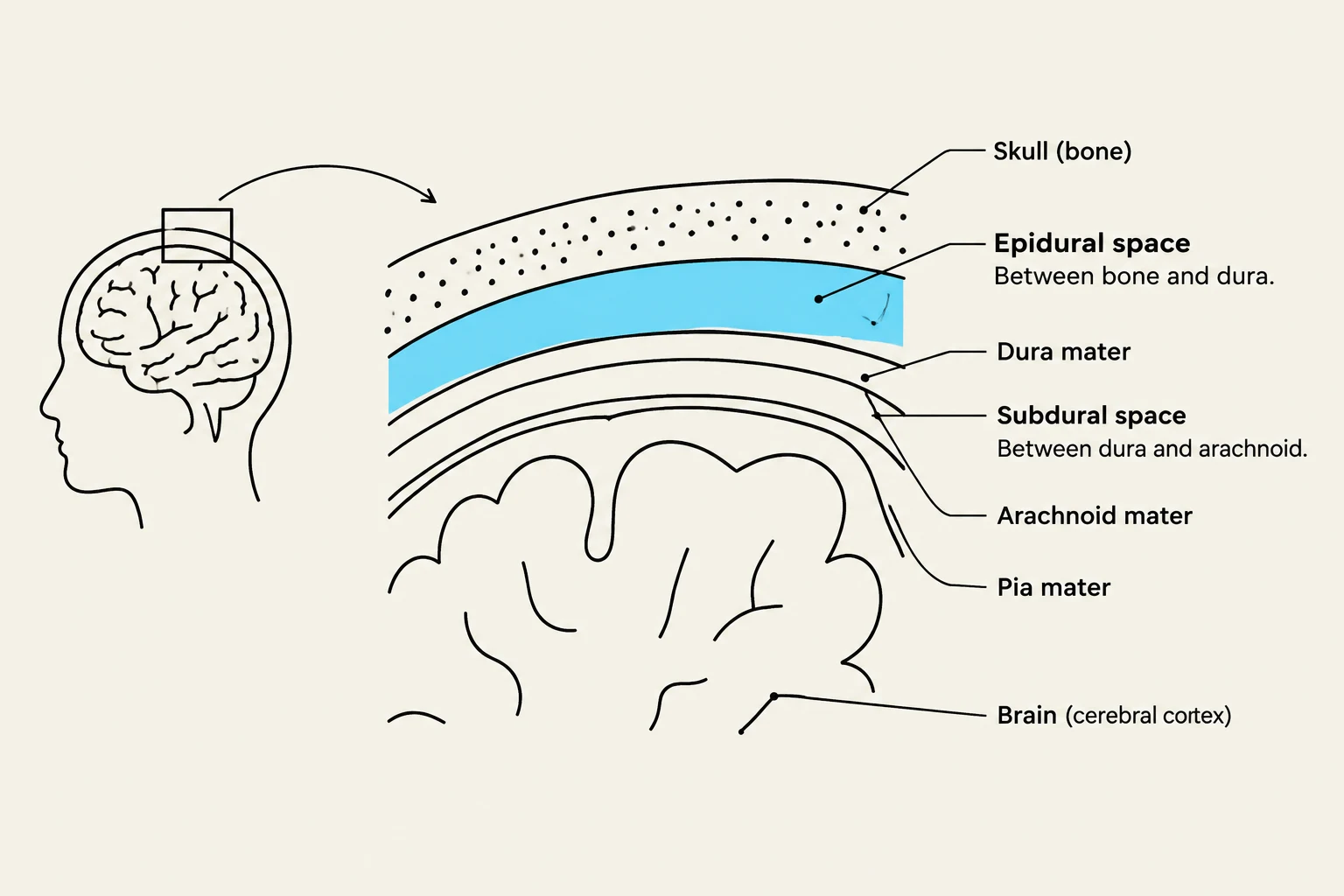 Diagram illustrating the layers covering the brain, including the skull, epidural space, dura mater, subdural space, arachnoid mater, and pia mater.
