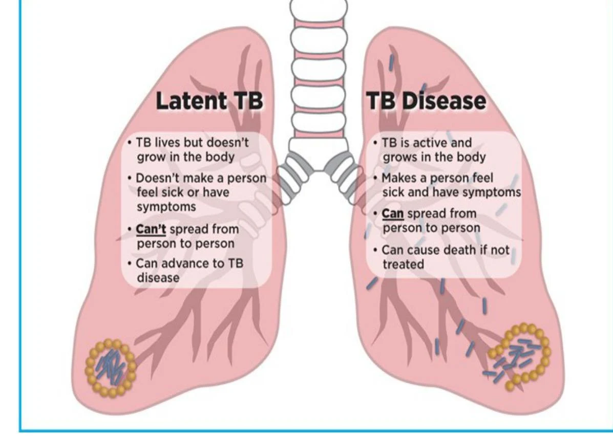 This illustration compares latent tuberculosis infection (LTBI) with active tuberculosis disease, highlighting key differences in bacterial activity, symptom presentation, transmissibility, and potential outcomes.