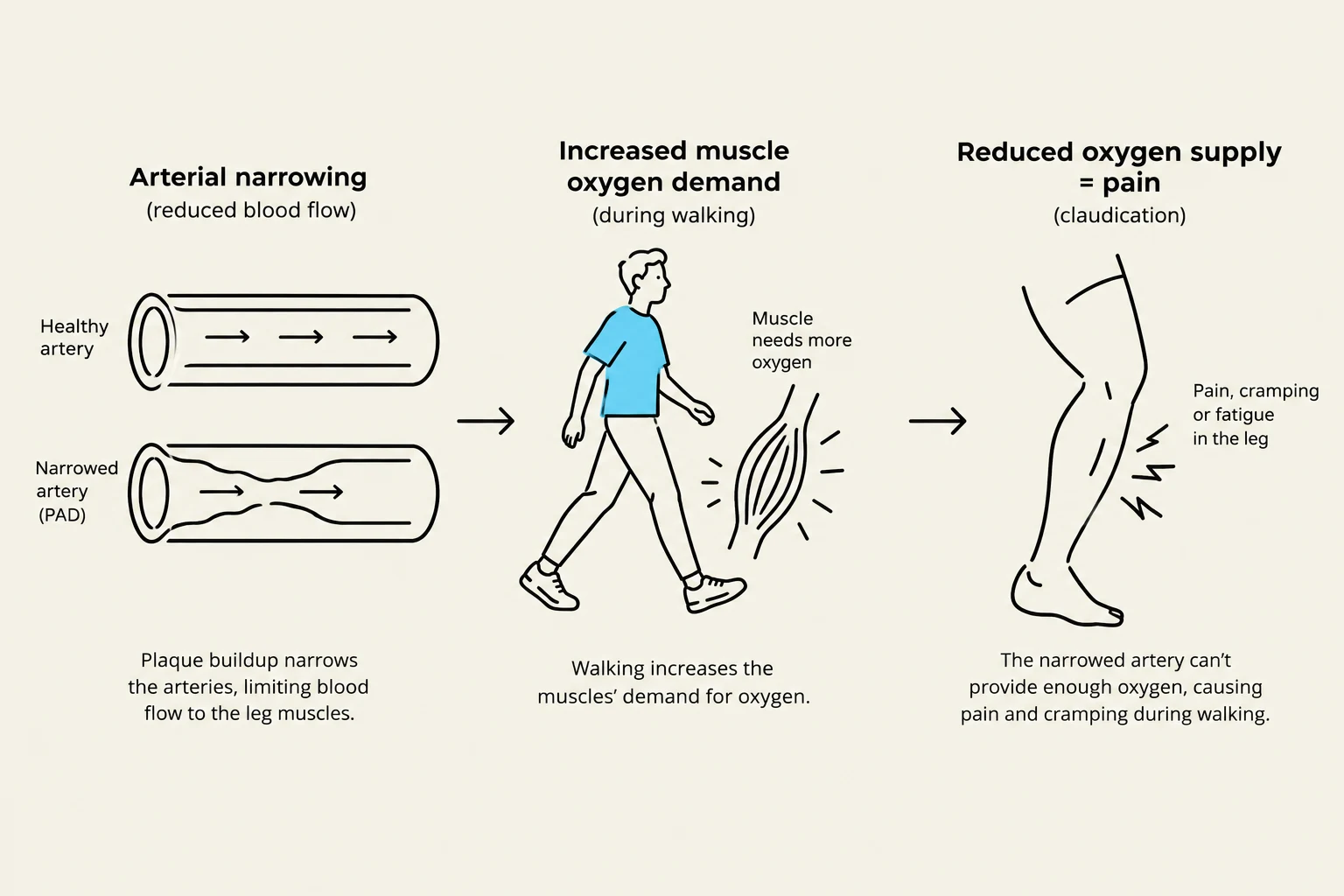 This diagram illustrates how arterial narrowing, caused by plaque buildup, can lead to reduced blood flow and pain in the legs during walking due to insufficient oxygen supply to the muscles.