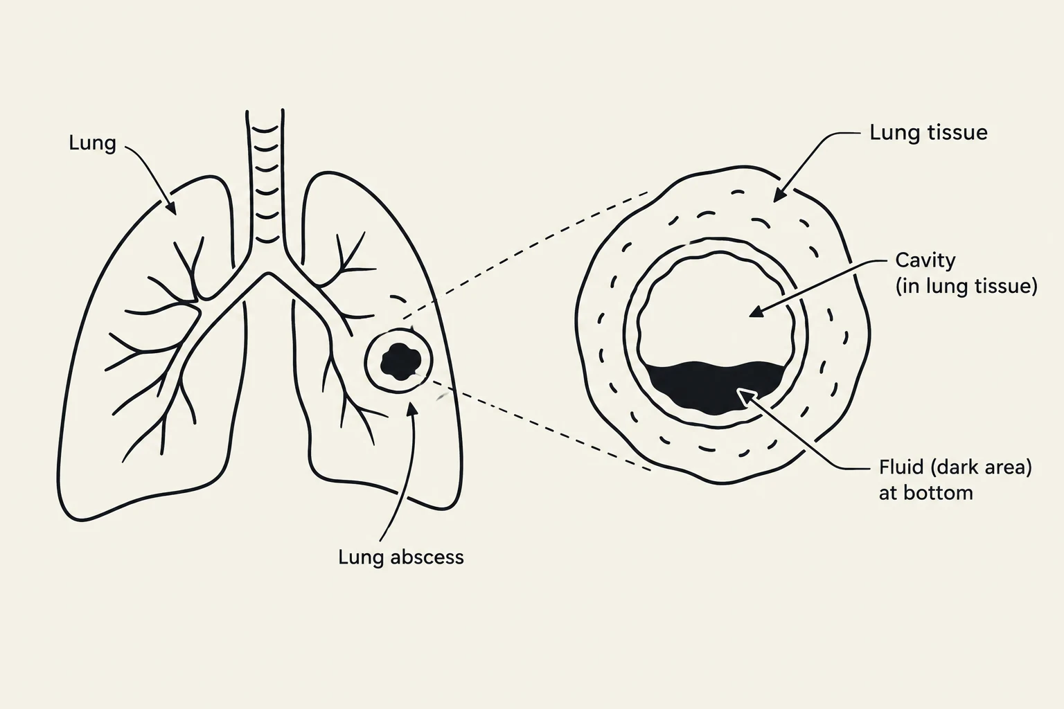 Diagram illustrating a lung abscess, showing a cavity within the lung tissue containing fluid.