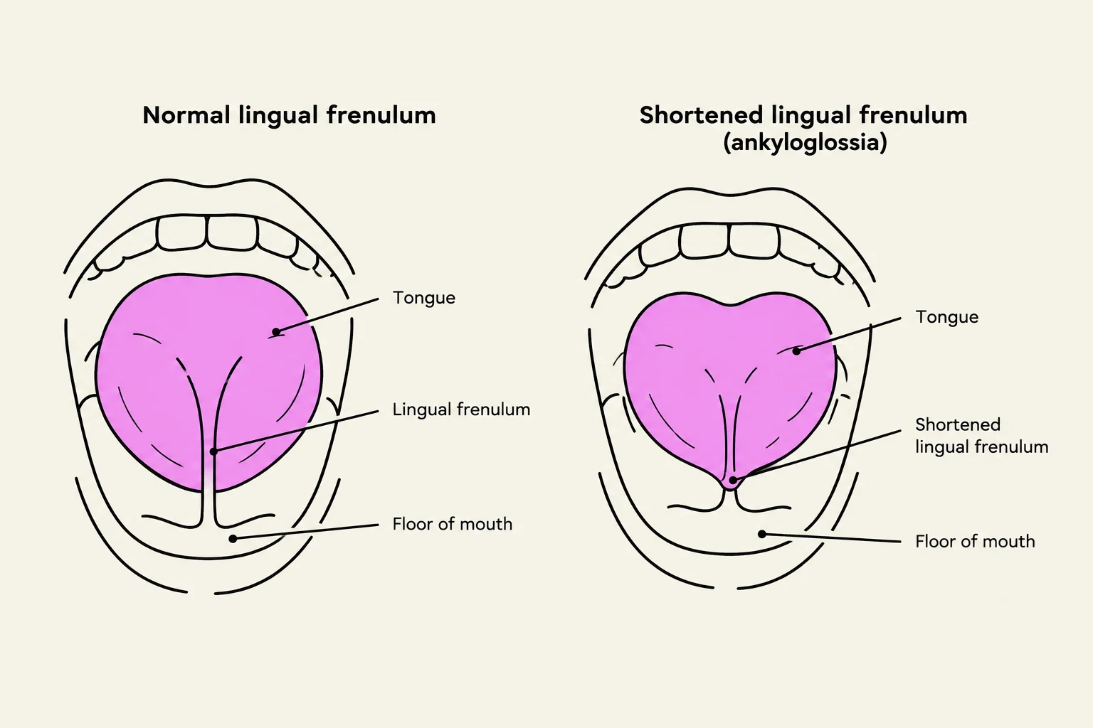 Diagrams illustrating a normal lingual frenulum and a shortened lingual frenulum (ankyloglossia).