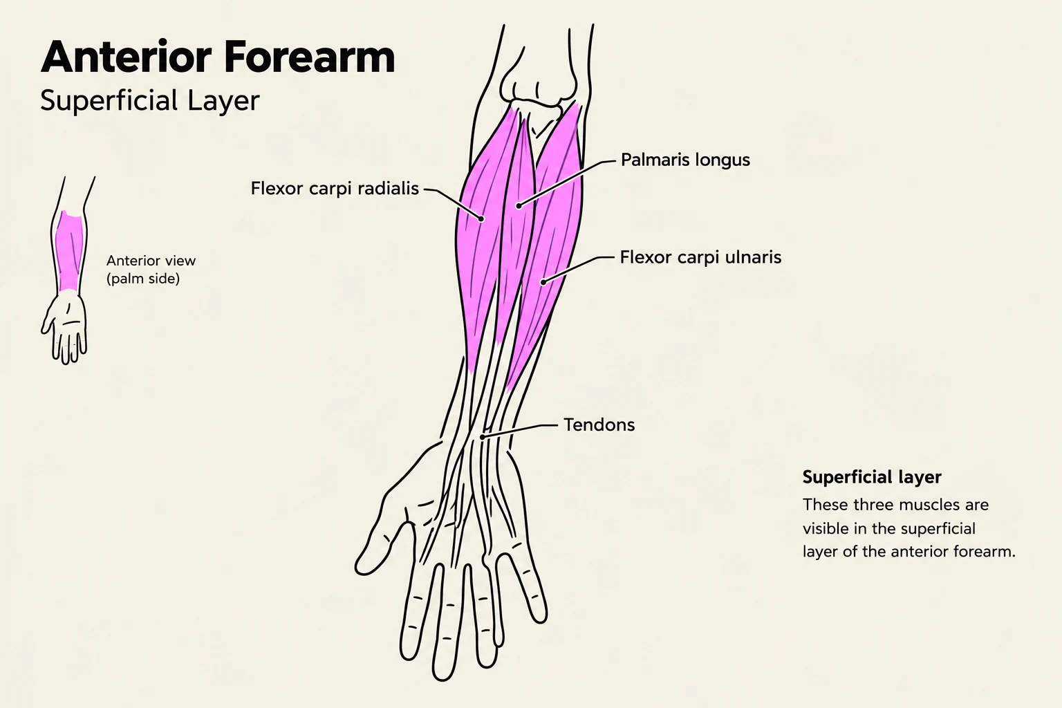 An illustration of the superficial layer of muscles in the anterior forearm, including the Palmaris longus, Flexor carpi radialis, and Flexor carpi ulnaris.