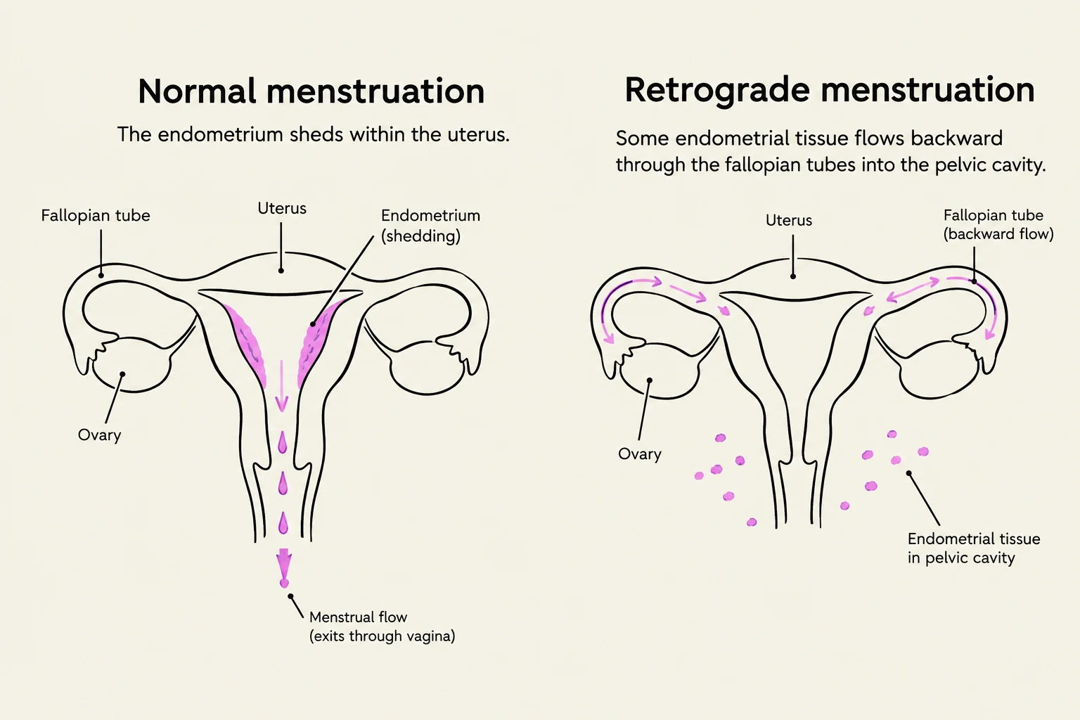 Diagrams illustrating normal menstruation where the endometrium sheds within the uterus and retrograde menstruation where endometrial tissue flows backward through the fallopian tubes into the pelvic cavity.