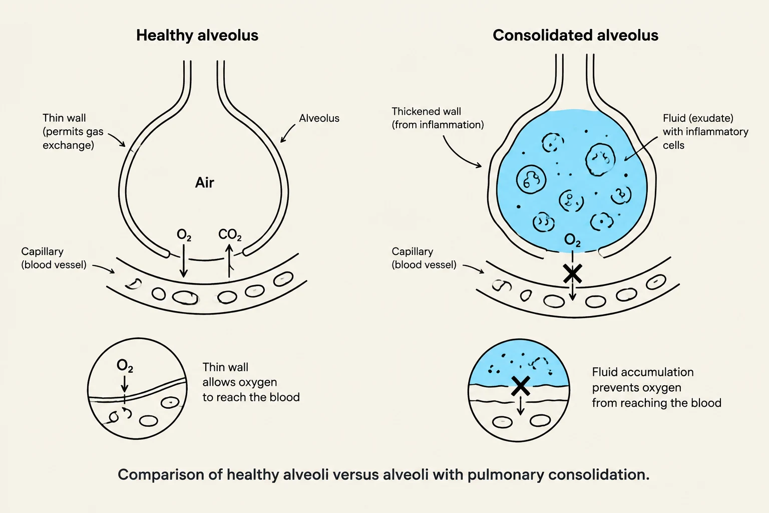 Comparison of healthy alveoli versus alveoli with pulmonary consolidation.