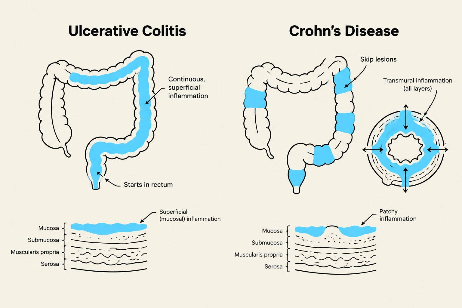 Diagrams illustrating the differences in inflammation patterns between Ulcerative Colitis and Crohn's Disease, including their location and depth within the intestinal wall.
