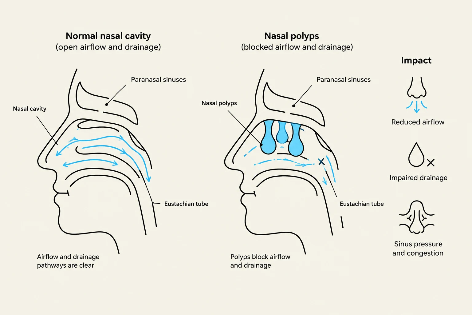 Diagram illustrating the difference between a normal nasal cavity with clear airflow and drainage, and a nasal cavity affected by polyps, leading to blocked airflow, impaired drainage, and sinus pressure.