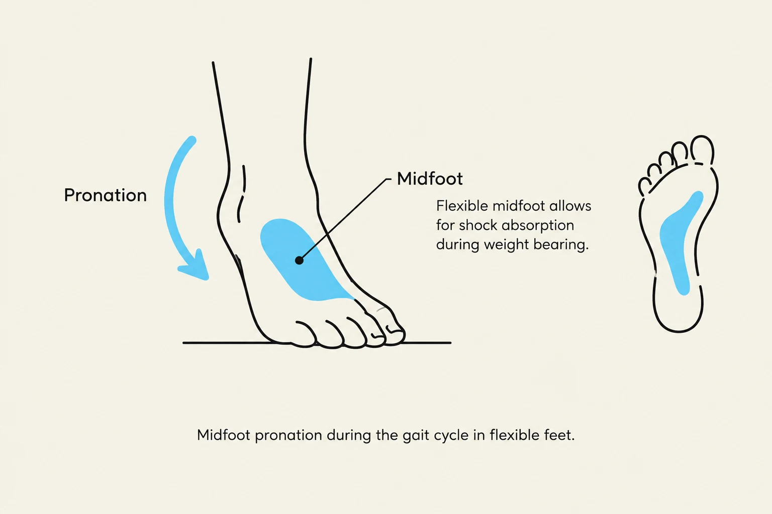 Midfoot pronation during the gait cycle in flexible feet.
