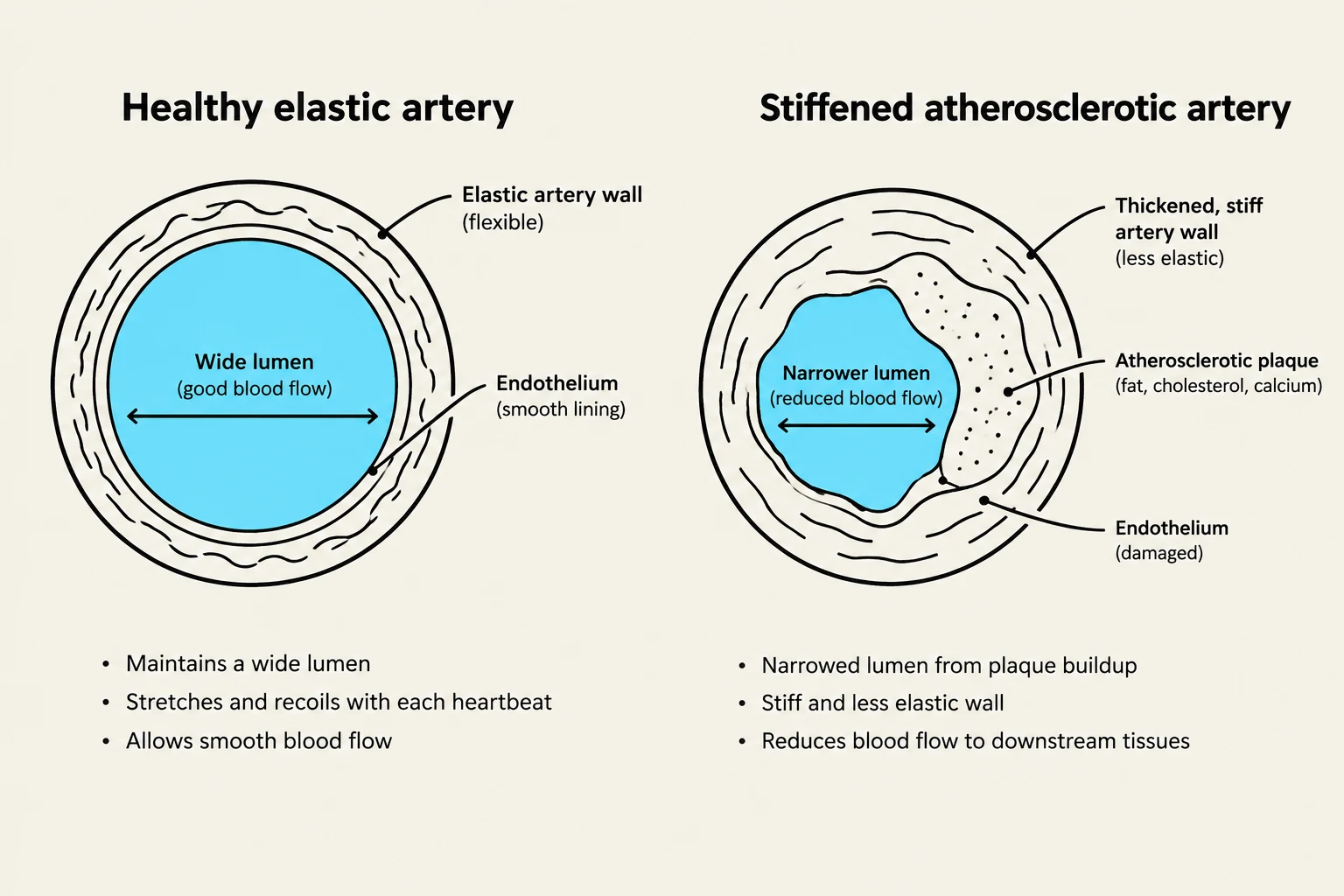 Comparison of a healthy elastic artery with a wide lumen and good blood flow, and a stiffened atherosclerotic artery with a narrowed lumen due to plaque buildup, reduced elasticity, and impaired blood flow.