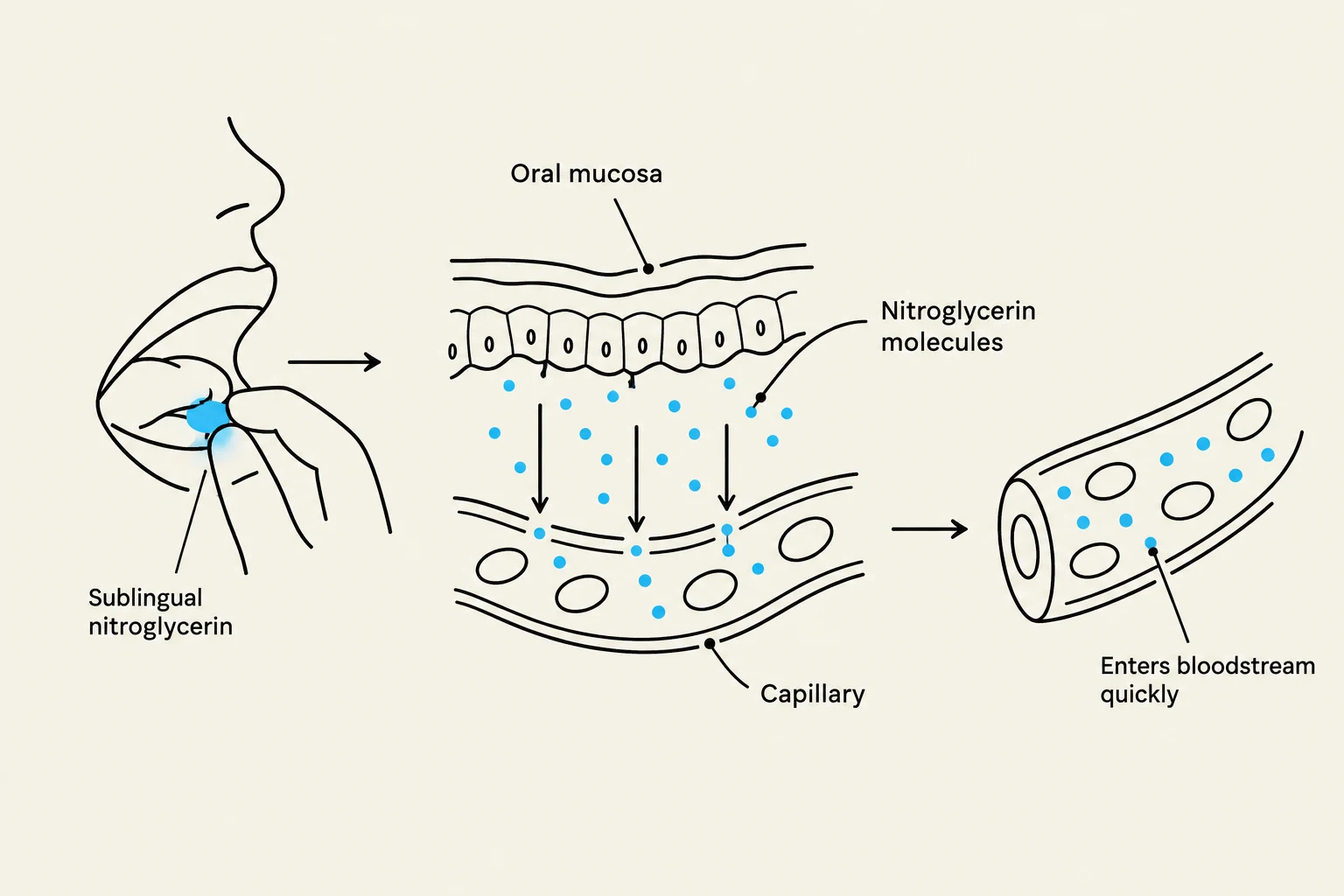 Diagram illustrating the sublingual absorption of nitroglycerin molecules into the bloodstream via capillaries.