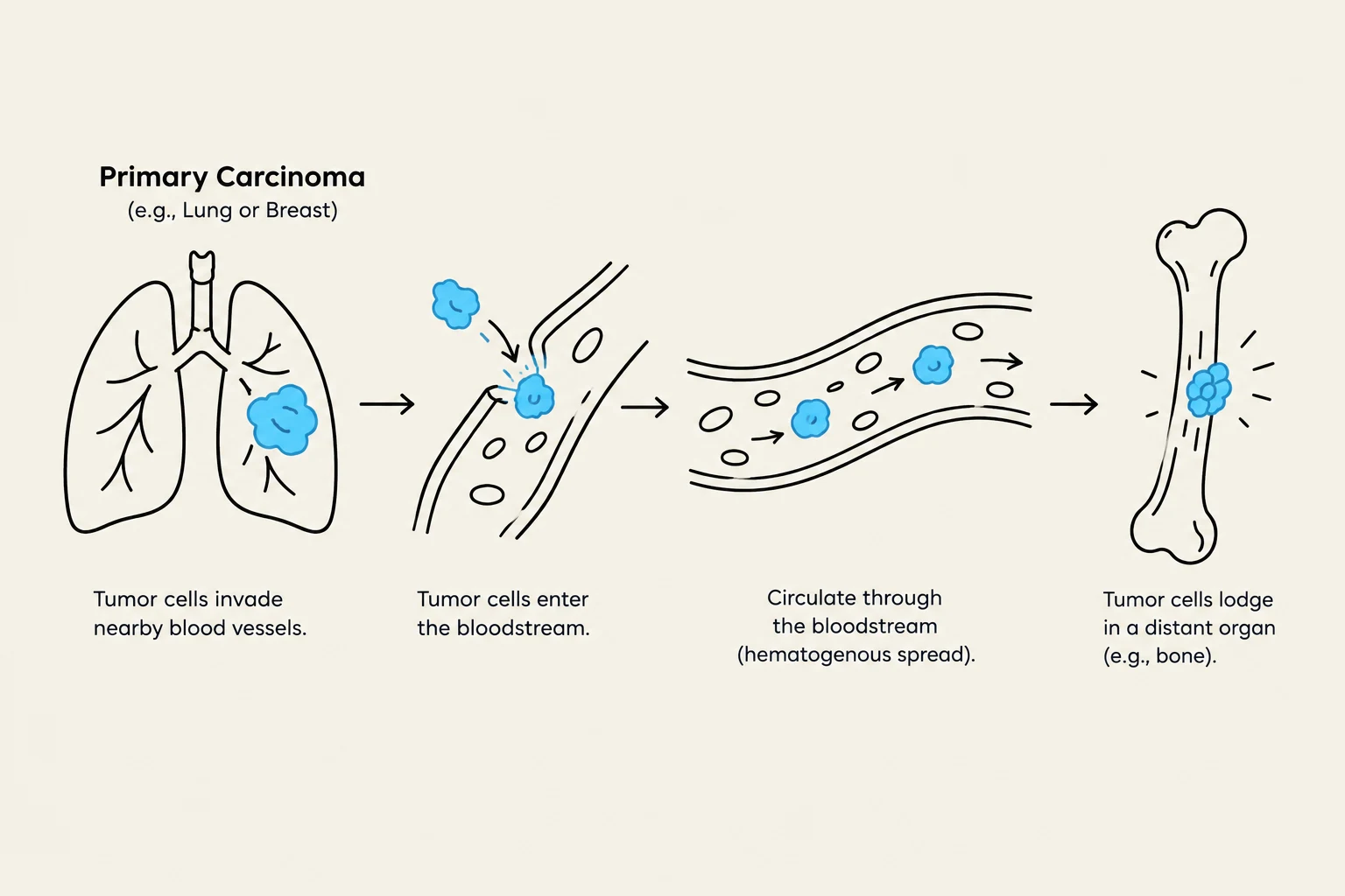 Diagram illustrating the process of primary carcinoma metastasis, showing tumor cells invading blood vessels, entering the bloodstream, circulating, and lodging in a distant organ like bone.