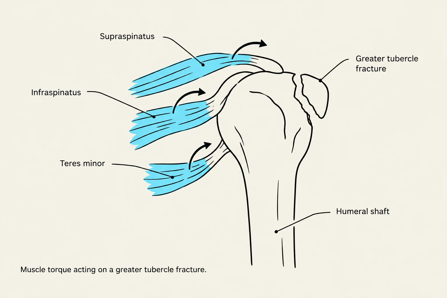 Diagram illustrating muscle torque acting on a greater tubercle fracture of the humerus, showing the supraspinatus, infraspinatus, and teres minor muscles.
