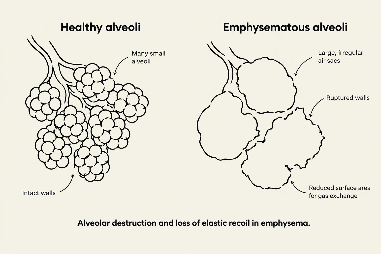Comparison of healthy alveoli with emphysematous alveoli, illustrating alveolar destruction and loss of elastic recoil in emphysema.