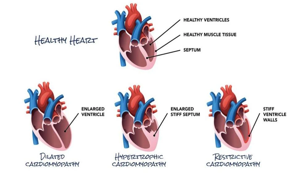 Diagram illustrating a healthy heart and three types of cardiomyopathy: dilated, hypertrophic, and restrictive, highlighting key differences in ventricular size, septum thickness, and wall stiffness.