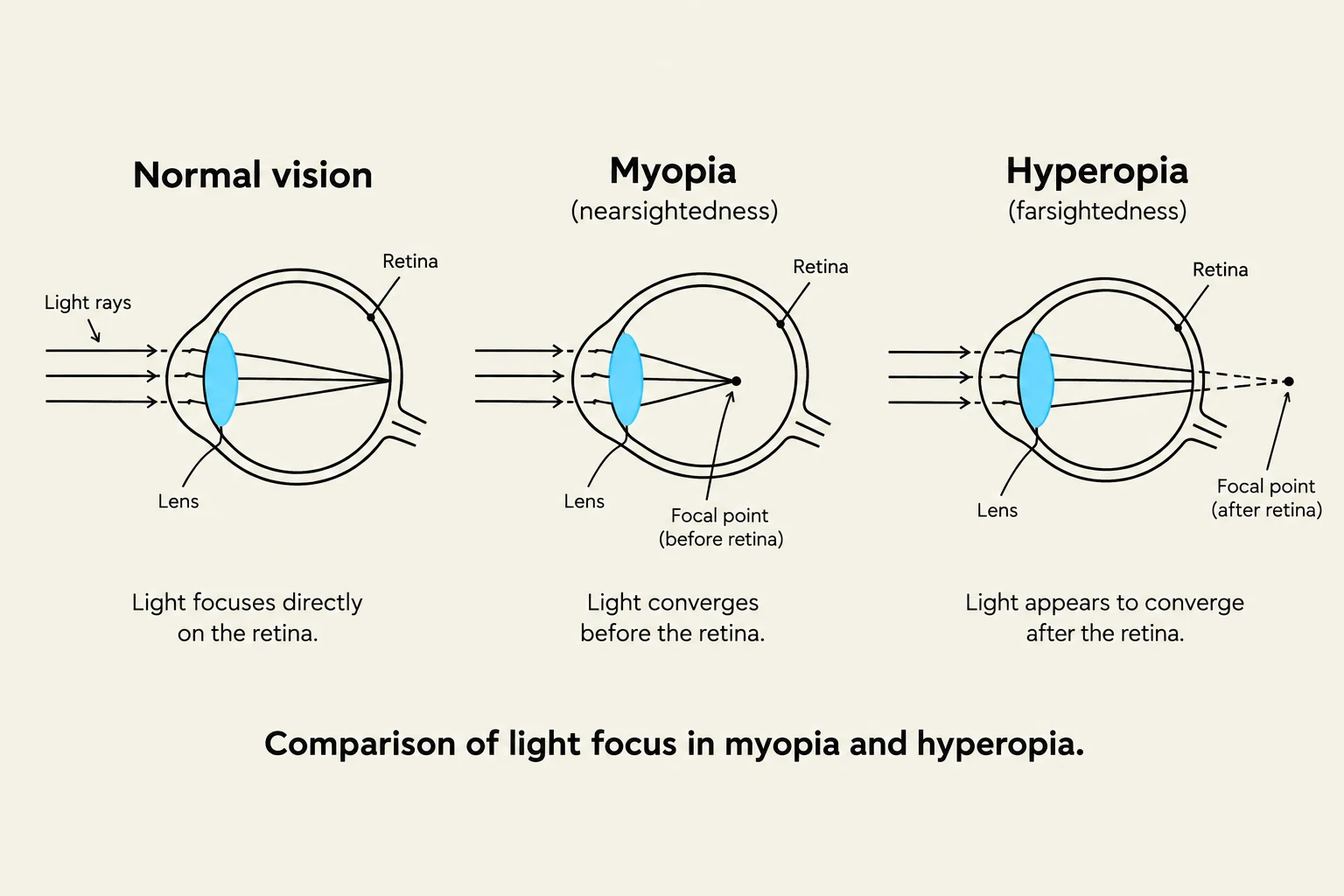 Comparison of light focus in myopia and hyperopia.