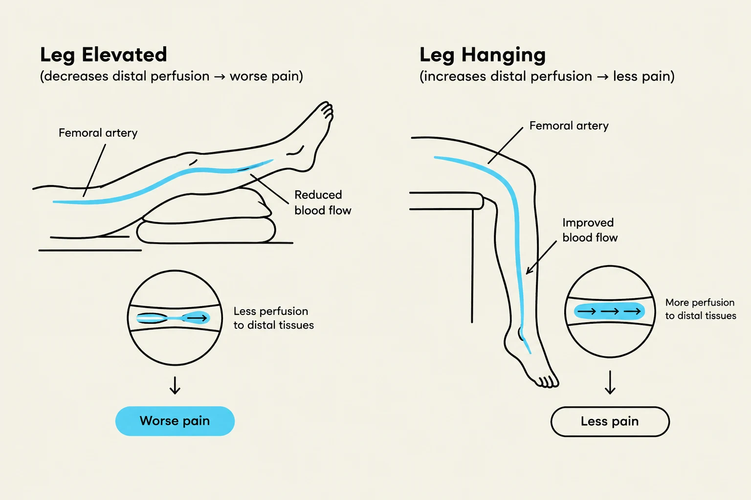 Diagram illustrating the effect of leg elevation and leg hanging on distal perfusion and pain.
