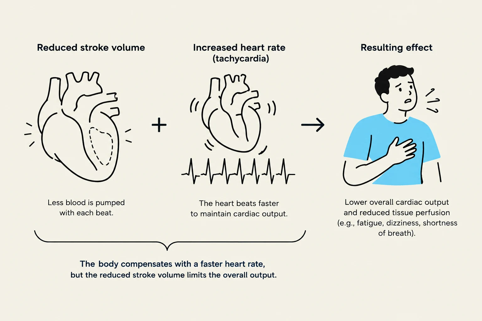 This diagram illustrates how reduced stroke volume, combined with an increased heart rate (tachycardia), leads to lower overall cardiac output and reduced tissue perfusion, resulting in symptoms like fatigue, dizziness, and shortness of breath.