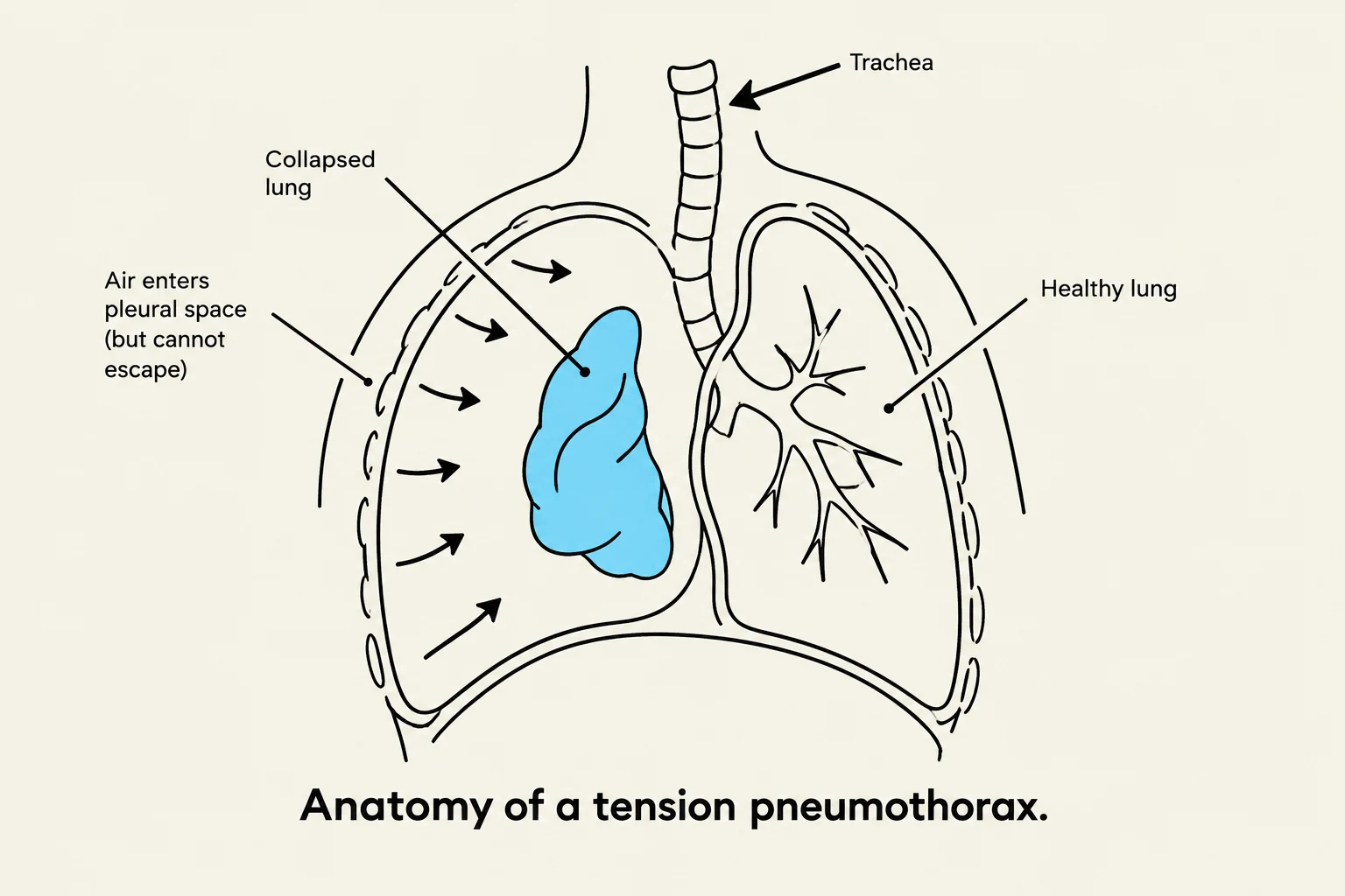 Anatomy of a tension pneumothorax, illustrating a collapsed lung due to air entering the pleural space.