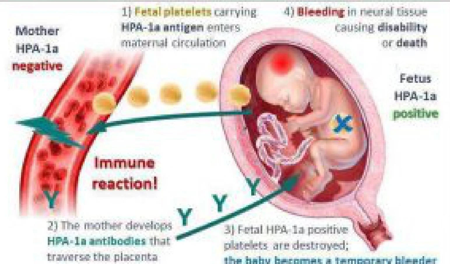 This diagram illustrates the process of hemolytic disease of the fetus and newborn, where maternal antibodies attack fetal platelets.