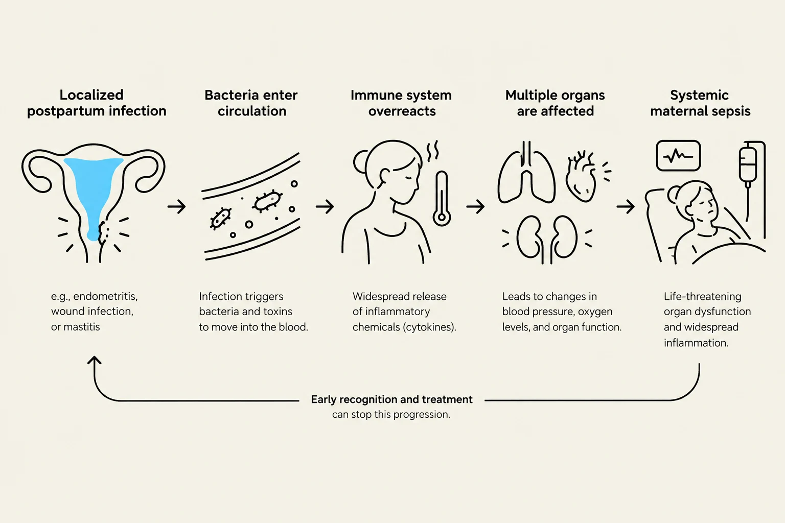 This diagram illustrates the progression of localized postpartum infection to systemic maternal sepsis, highlighting the role of bacterial circulation, immune system overreaction, organ involvement, and the importance of early recognition and treatment.