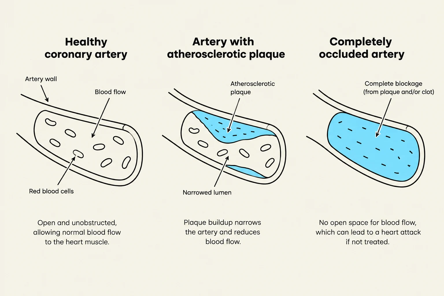 Diagram illustrating the progression of coronary artery blockage from healthy to completely occluded due to atherosclerotic plaque, which can lead to a heart attack.