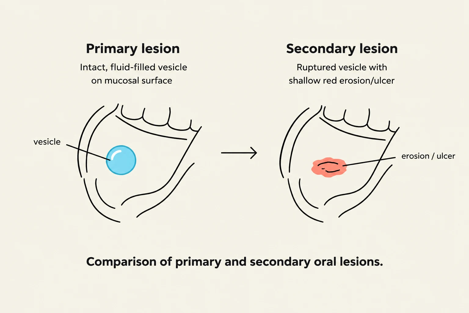 Comparison of primary and secondary oral lesions, illustrating a vesicle evolving into an erosion or ulcer.