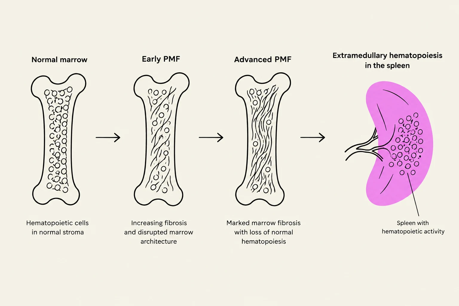 Diagram illustrating the progression of myelofibrosis, showing changes in bone marrow and the development of extramedullary hematopoiesis in the spleen.
