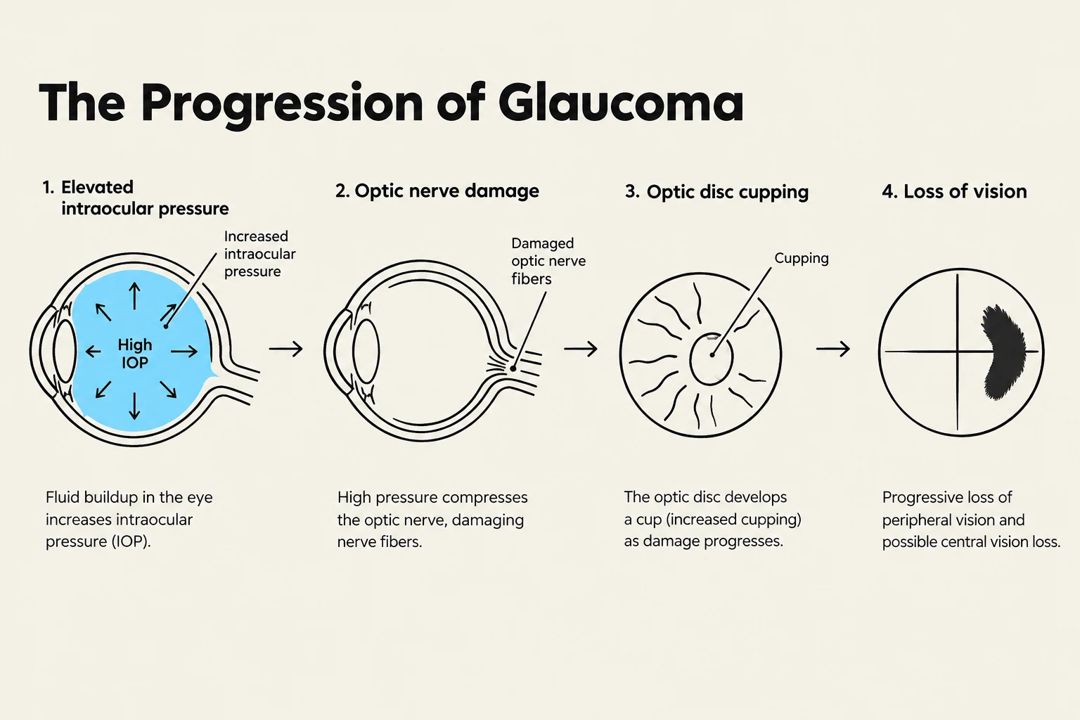 The progression of glaucoma is illustrated, showing elevated intraocular pressure leading to optic nerve damage, optic disc cupping, and eventual loss of vision.
