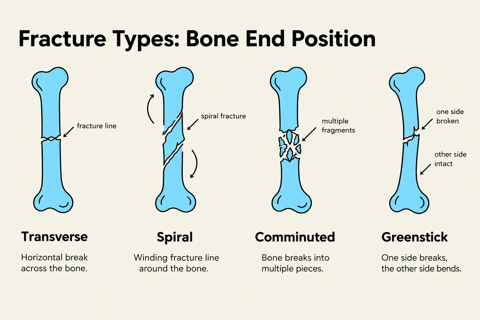 This illustration displays four types of bone fractures: Transverse, Spiral, Comminuted, and Greenstick, with descriptions of each.