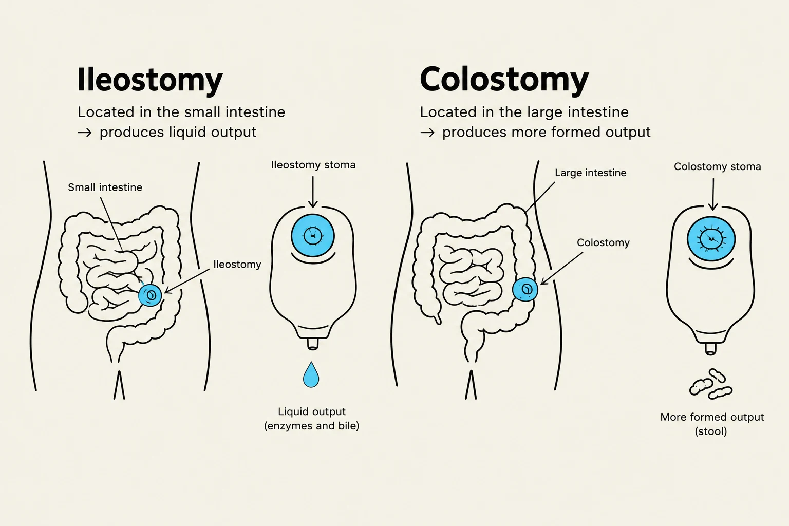 Diagram illustrating the difference between an ileostomy and a colostomy, showing their locations in the digestive system and the type of output produced.