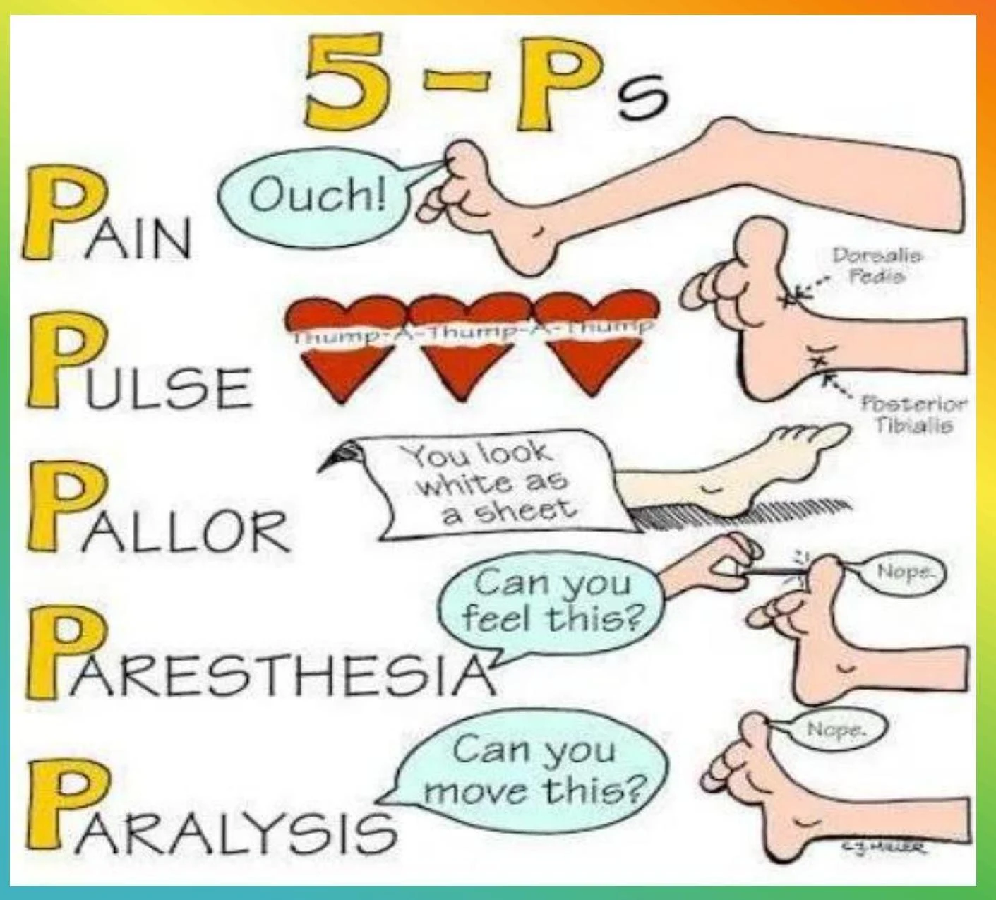 The 5 Ps (Pain, Pulse, Pallor, Paresthesia, Paralysis) are a mnemonic used to assess for compartment syndrome.