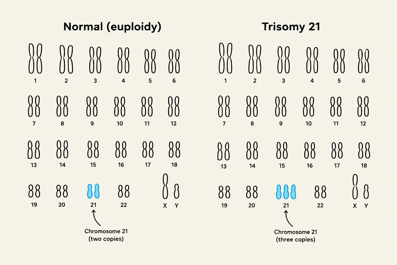 This diagram illustrates the difference between normal euploidy, where individuals have two copies of each chromosome, and Trisomy 21, a condition characterized by three copies of chromosome 21, which causes Down syndrome.
