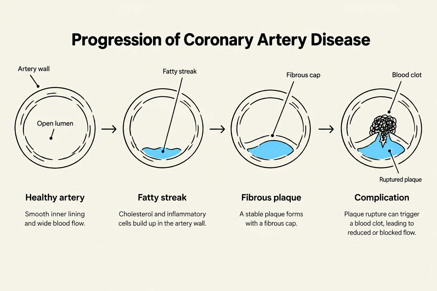 The progression of coronary artery disease is illustrated, showing the development from a healthy artery to a fatty streak, then a fibrous plaque, and finally a complication involving a blood clot due to plaque rupture.